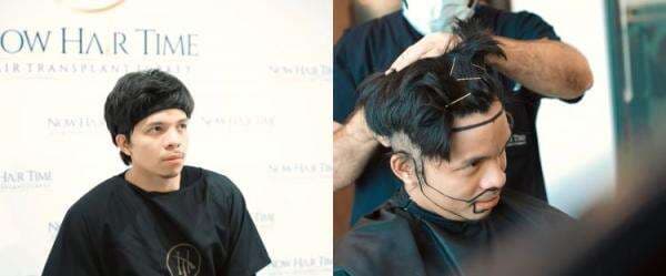 Tak pede berjidat lebar, 9 potret Atta Halilintar transplantasi rambut