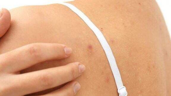 7 Hal Sepele yang Bikin Jerawat Punggung Merajalela