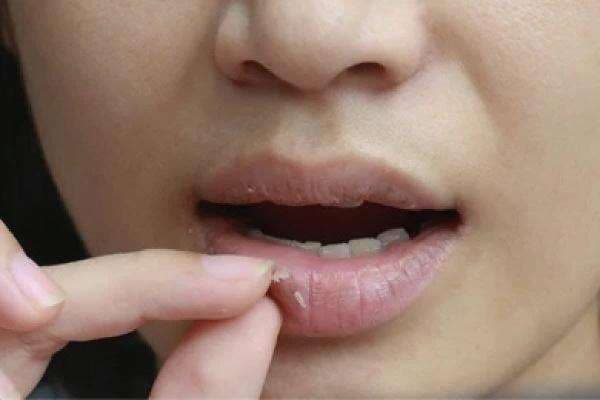 Simak Cara Mengatasi Bibir Pecah-Pecah