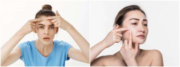 11 Cara menghilangkan milia di wajah secara alami, mudah diaplikasikan