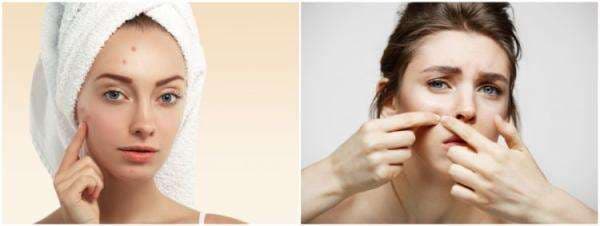 11 Rekomendasi pelembap wajah kulit berjerawat, harga puluhan ribu