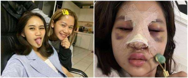 Alami efek samping usai oplas, ini 9 foto terbaru putri Farida Nurhan