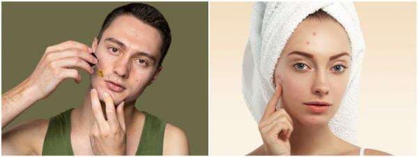 9 Serum lokal untuk kulit berjerawat, harga terjangkau