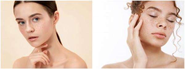 9 Penyebab flek hitam di wajah dan cara mengatasinya