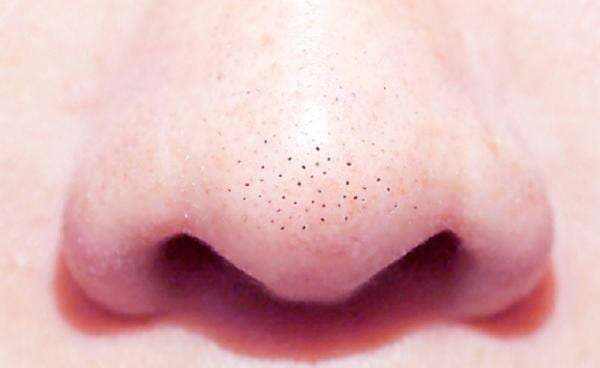 7 Cara Alami Untuk Menghilangkan Komedo, Kamu Wajib Tahu!