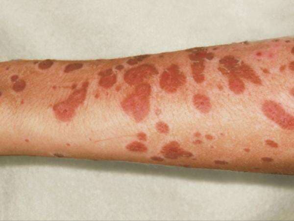 Mengenal Steven Johnson Syndrom, Penyakit Akibat Alergi Obat yang Bisa Bikin Kulit Perih