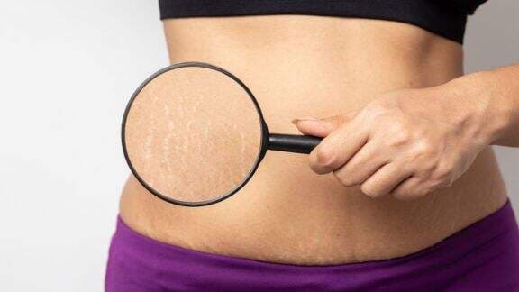 Patut Dicoba! 6 Cara Menghilangkan Stretch Mark, Bye-bye Stretch Mark