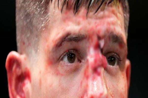 Sadis! Hidung Petarung MMA Pecah Bersimbah Darah Dipukuli Brutal