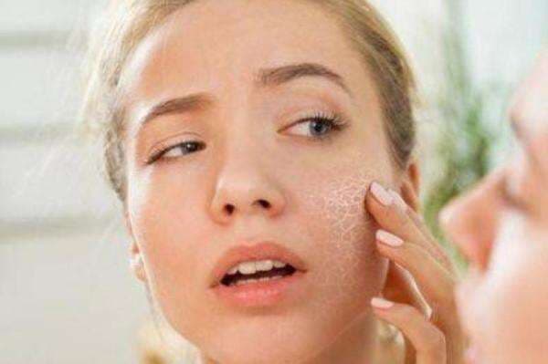 3 Vitamin Penting untuk Kulit Kering dan Kusam, Wajib Coba!