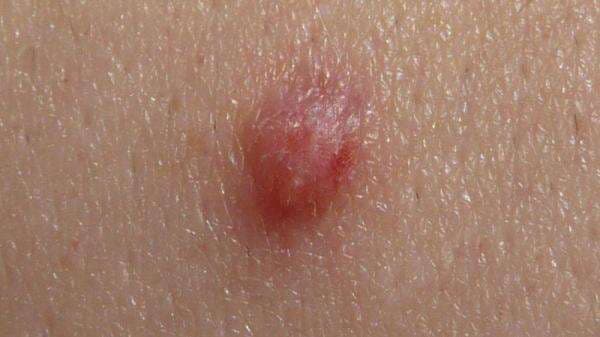 Banyak Benjolan di kulit, Ketahui Jenis Penyakitnya