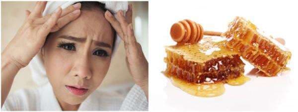 11 Cara menghilangkan biang keringat di wajah dengan bahan alami