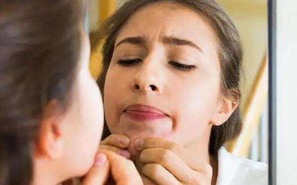 10 Arti Letak Jerawat di Wajah, Bagian Bibir Pertanda Gangguan Pencernaan