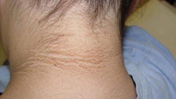 10 Gejala Penyakit Kencing Manis yang Sering Disepelekan, Waspada Ya Moms!