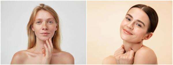 Mengenal freckles wajah, penyebab dan cara mengatasinya