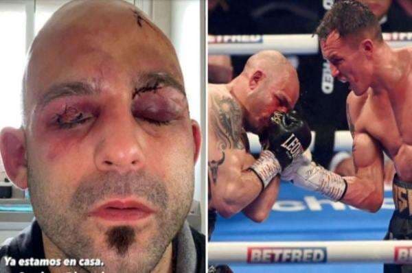 Mengerikan! Mata Kiko Martinez Bonyok Dihajar Josh Warrington Mengerikan! Mata Kiko Martinez Bonyok Dihajar Josh Warrington