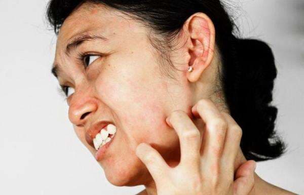 Cara Mengobati Gatal Alergi Secara Alami, Gak Pakai Ribet!