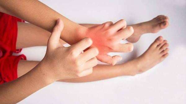 Alergi Debu Pada Kulit, Kenapa Bisa Terjadi?