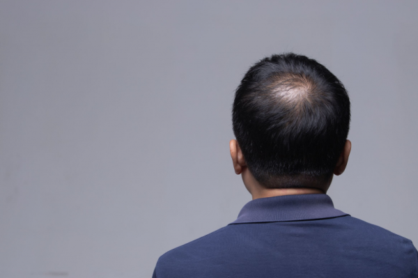 Alopecia Areata, Gangguan Autoimun Bikin Rambut Rontok