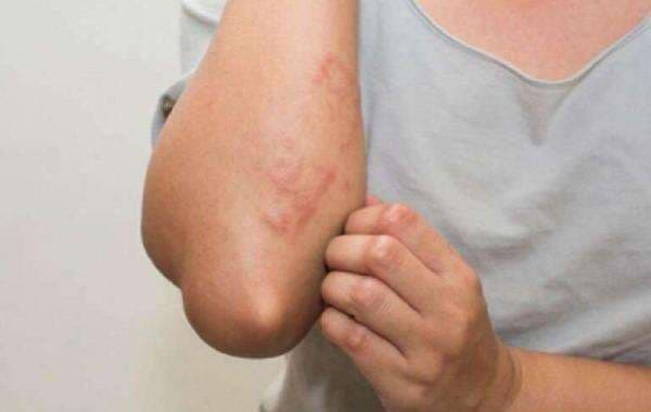 Apa Penyebab Biduran? Lengkap dengan Gejala dan Pengobatannya