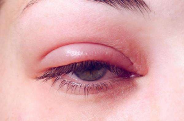 Cara Mengobati Mata Bintitan, Simak Yuk!