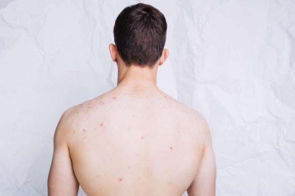 Kenali 4 Jenis Bisul yang Membahayakan