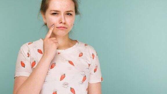 Begini Cara Hilangkan Bopeng Bekas Jerawat Beauty! Yeay... Nggak Minder Lagi