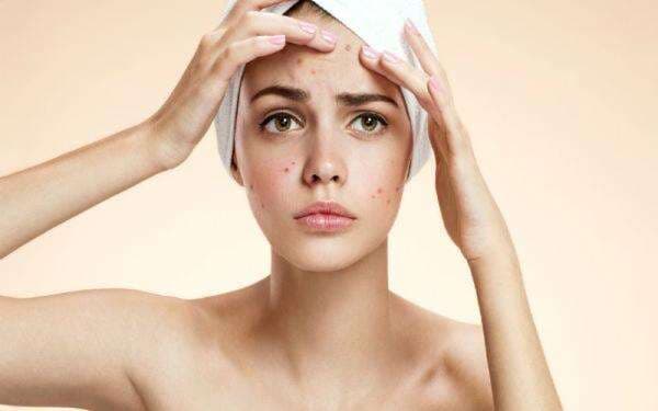 8 Jenis Jerawat: Penyebab dan Cara Mengatasinya