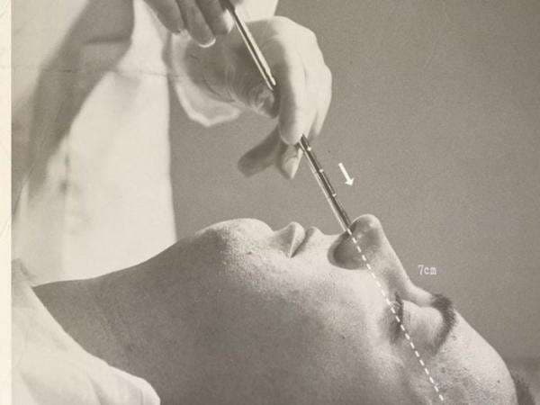 Sejarah Kelam Lobotomi, Ketika Ribuan Kepala Manusia Dilubangi untuk Pengobatan!