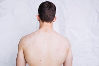 Cara Mudah Mengobati Bisul yang Sudah Pecah Tapi Masih Keras, Harus Rajin Mandi