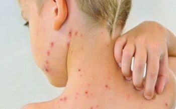 Kenali 6 Gejala Cacar Air dan 3 Tahapan Ruam yang Jadi Ciri Khas