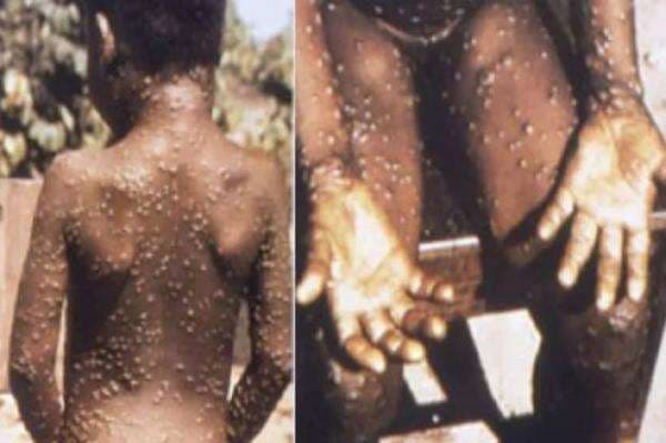 Publik China Ramai-ramai Bahas Teori Konspirasi AS Sebar Virus Cacar Monyet