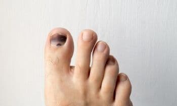 Apa itu Cantengan? Penyakit yang Berawal dari Hal Sepele