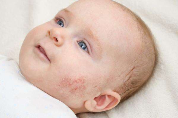 Penyebab dan Cara Mengatasi Jerawat pada Bayi, Simak Bunda!