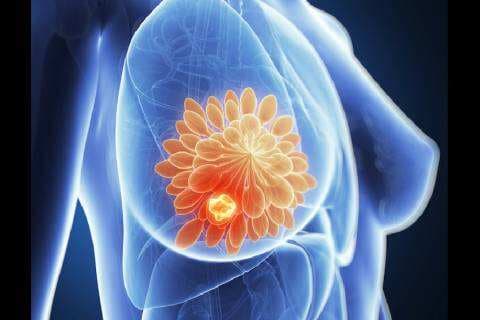 Kenali 4 Gejala Kanker Payudara Selain Benjolan, Nomor 3 Perubahan Bentuk Puting Kenali 4 Gejala Kanker Payudara Selain Benjolan, Nomor 3 Perubahan Bentuk Puting