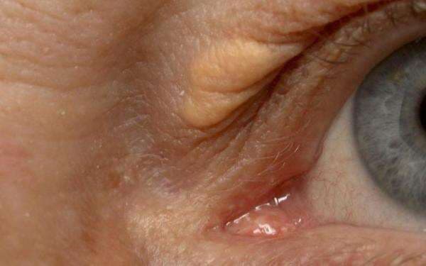 Kenali 3 Tanda Kolesterol Tinggi dari Mata