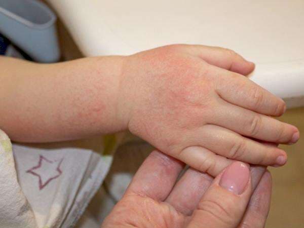 Harlequin Ichthyosis, Kelainan Kulit Bayi yang Disebabkan Oleh Mutasi Genetik