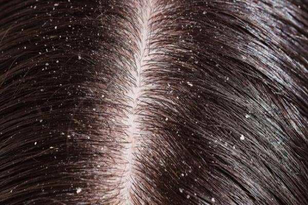 5 Bahan Alami untuk Menghilangkan Ketombe Membandel