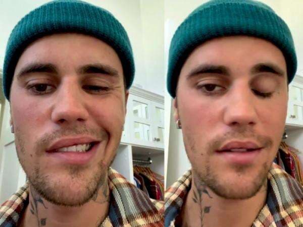 Justin Bieber Idap Ramsay Hunt Syndrome hingga Wajahnya Lumpuh Sebelah, Apa Penyebabnya?