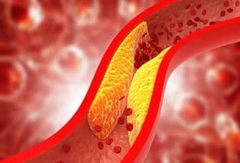 Orang Kurus Kena Kolesterol Tinggi, Kok Bisa?