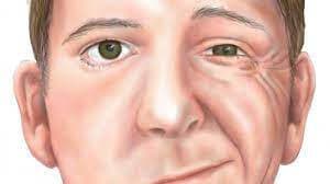 Mengenal Penyakit Bell`s Palsy yang Menyerang Wajah