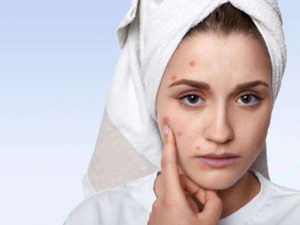 Sederet Penyebab Muncul Jerawat Pipi, Cegah dengan Cara Ini