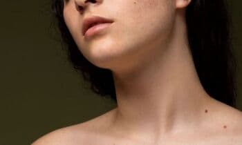 Tahi Lalat Tiba-Tiba Berubah? Jangan Diabaikan, Bisa Jadi Gejala Kanker Kulit!