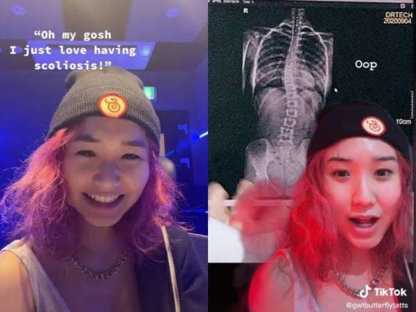 Diduga Jadi Alasan Denise Kim Hengkang dari Secret Number, Ini yang Perlu Kamu Tahu Tentang Skoliosis