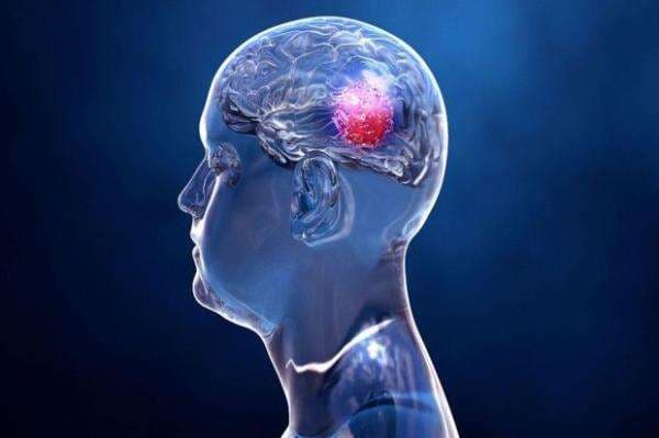 6 Penyebab Tumor Otak pada Wanita, Waspada Stres dan Merokok