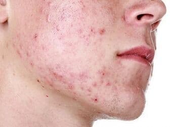 Viral Pria Kena Herpes Zoster, Apa karena Imun Tubuh Turun?