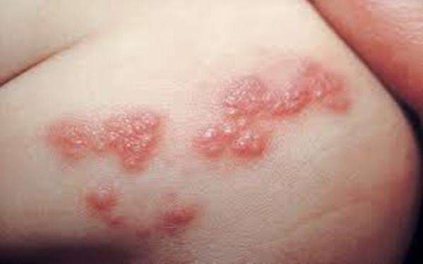 Menular Lewat Udara, Berikut 10 Fakta Tentang Herpes Zoster