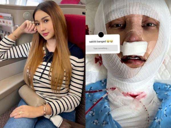 Lucinta Luna Operasi Pemotongan Leher, Ganti Suara Cowok Jadi Suara Kucing