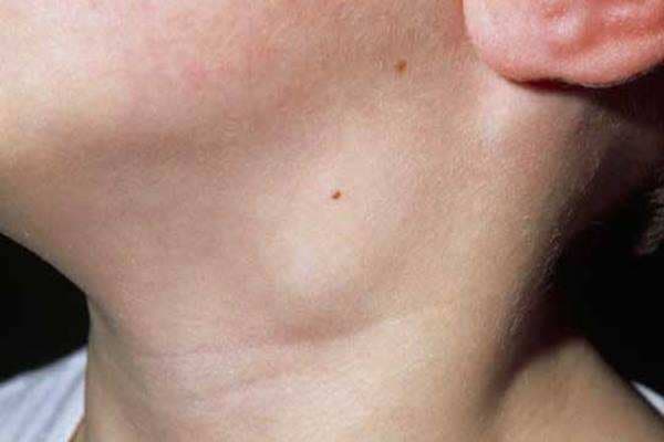 Waspada! Makanan Ini Bisa Picu Munculnya Kanker Kelenjar Getah Bening