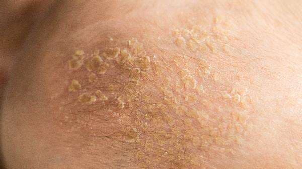 Ini Cara Mengobati Jamur Kulit yang Membandel, Jangan Panik!