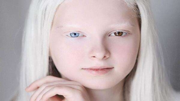 Amina Ependieva, Gadis Albino Asal Rusia yang Punya Warna Bola Mata Berbeda